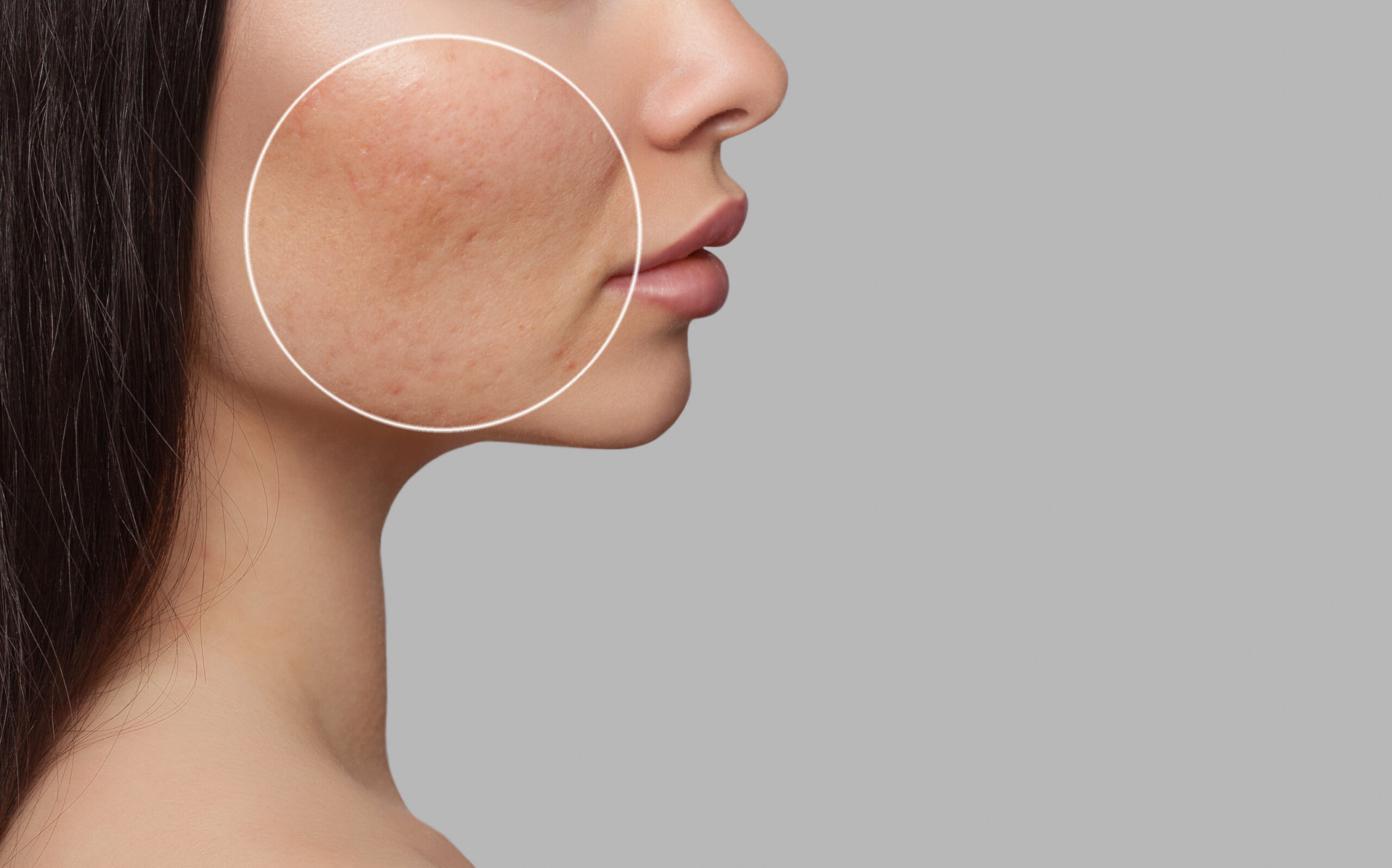 acne scars