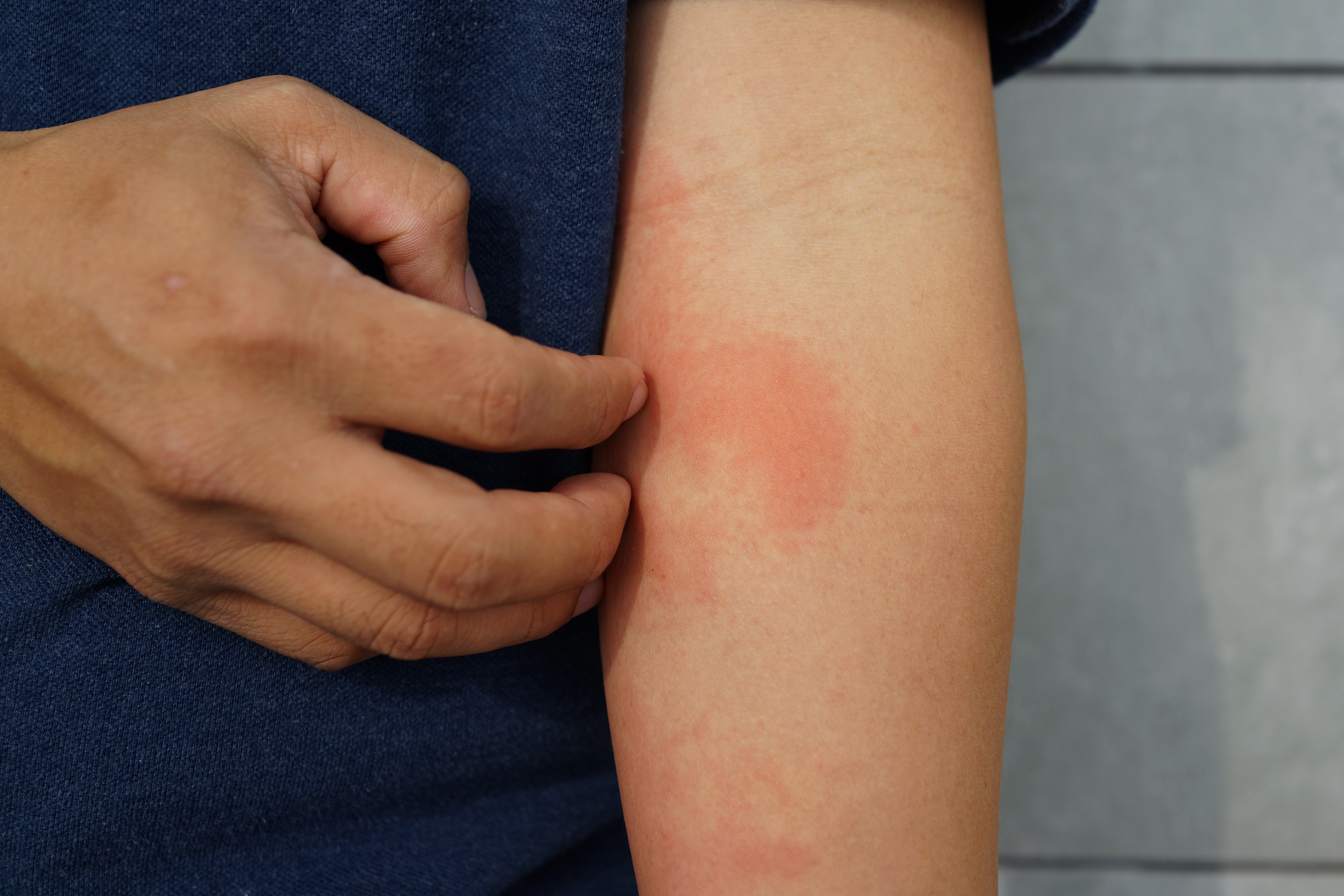 Allergic rash dermatitis eczema skin on forearm of patient.
