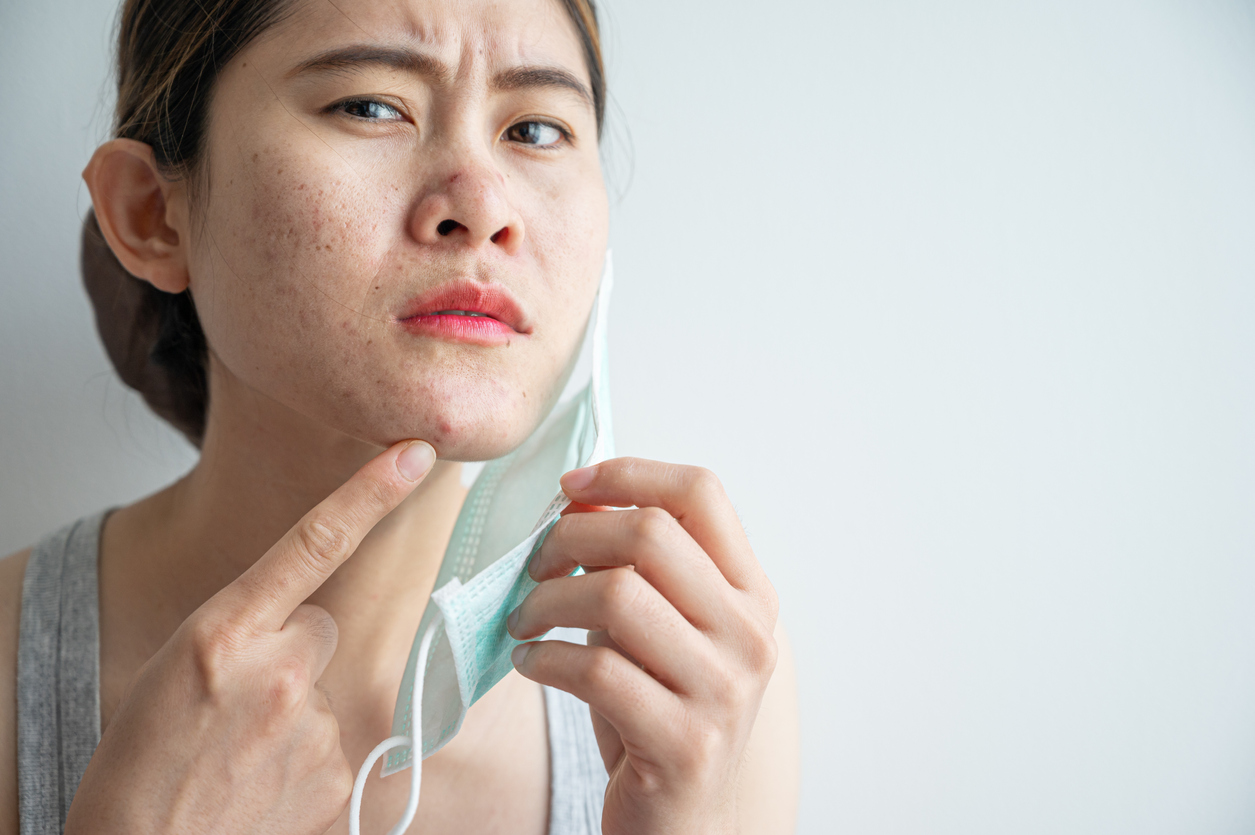 Asian woman worry about acne occur on her face after wearing mask for long time during covid-19 pandemic.