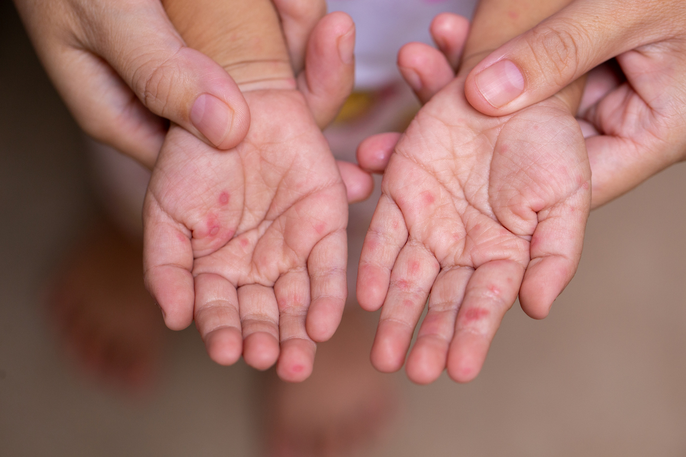 skin rash on kids