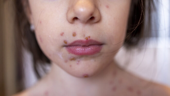 chicken pox measles