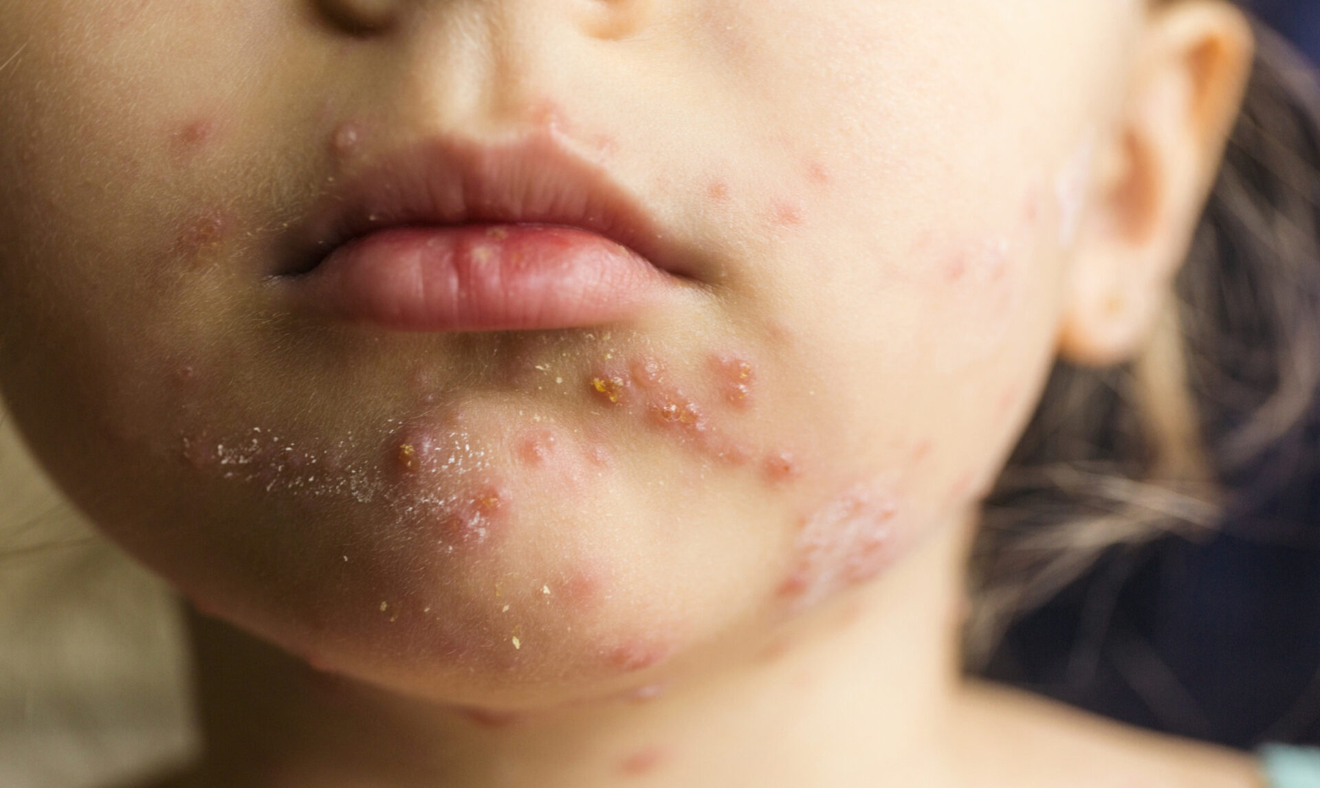chickenpox