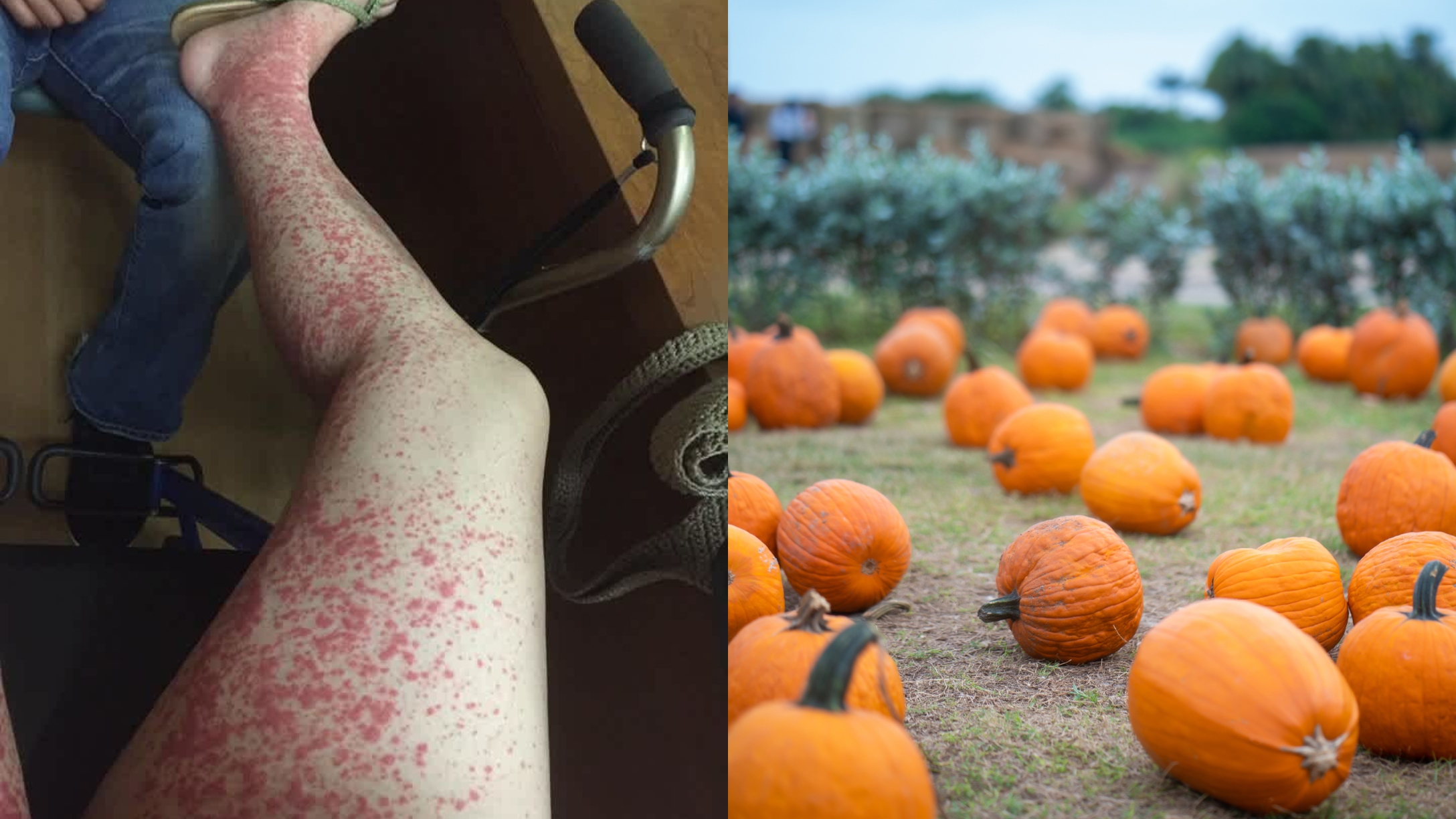 Rash from tick bite