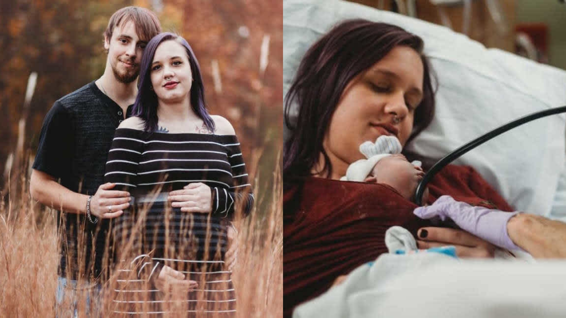Anencephaly spina bifida