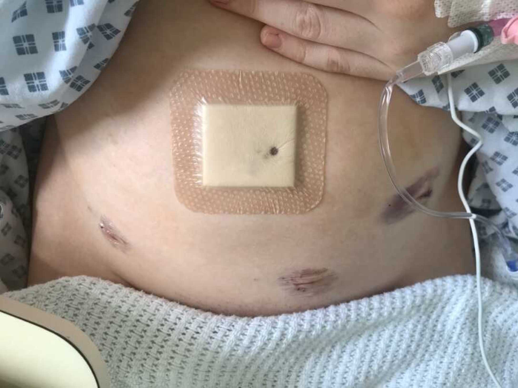 scars-from-endometriosis-surgery-900x675-1.jpeg
