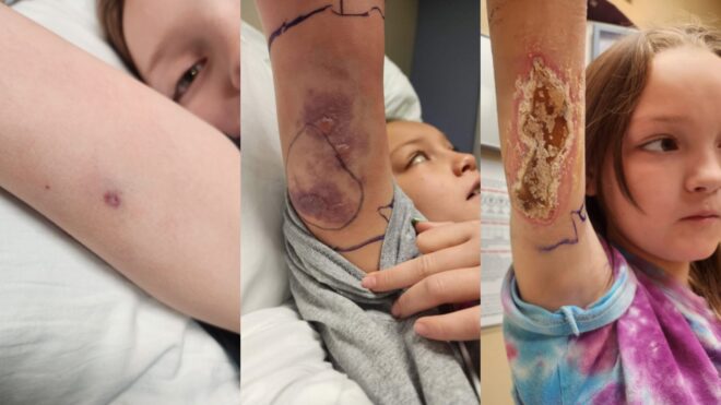 brown recluse spider bite