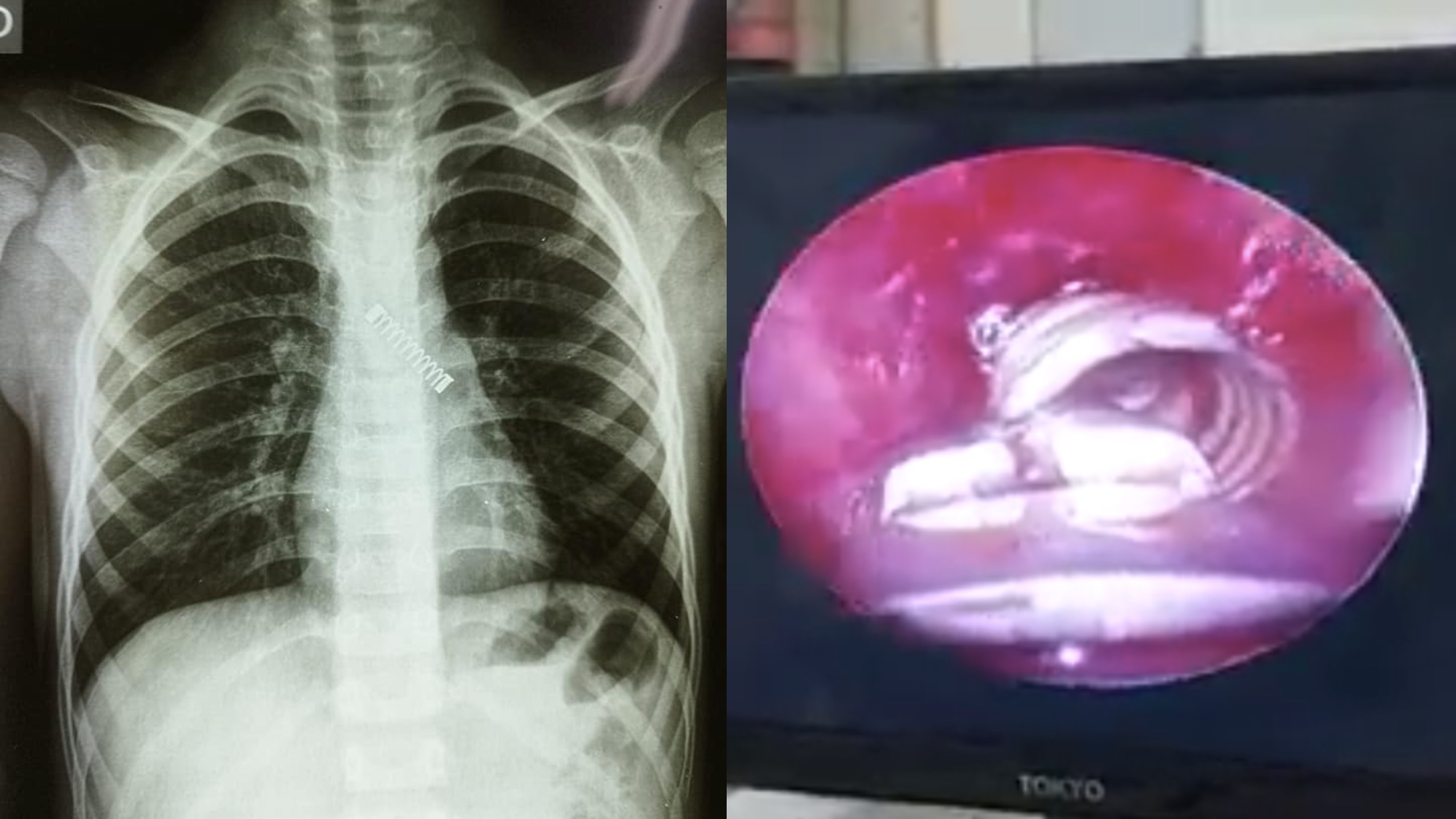 metal spring in lung x ray