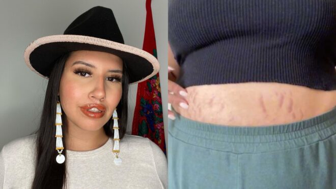 stretch marks