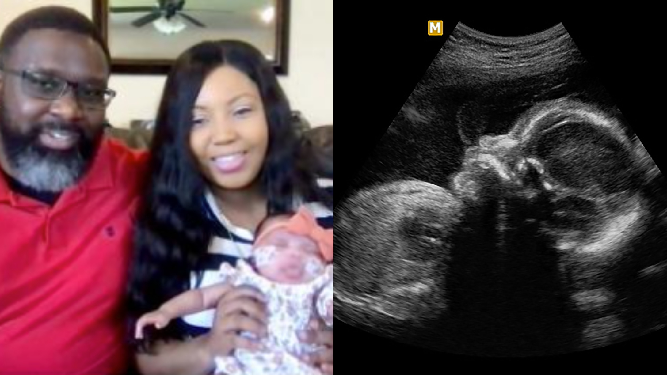 fetal brain surgery