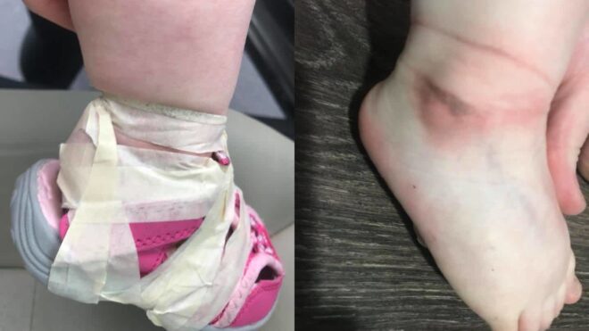 Shoes tapped to toddler's feet.