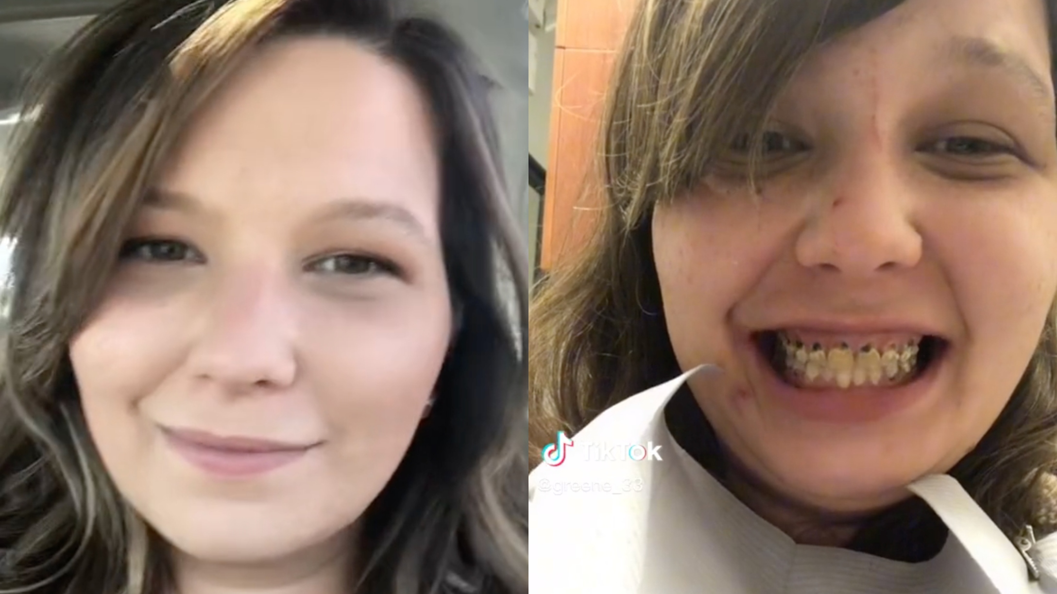 pregnancy tooth decay