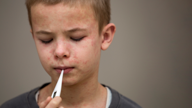 child with measles