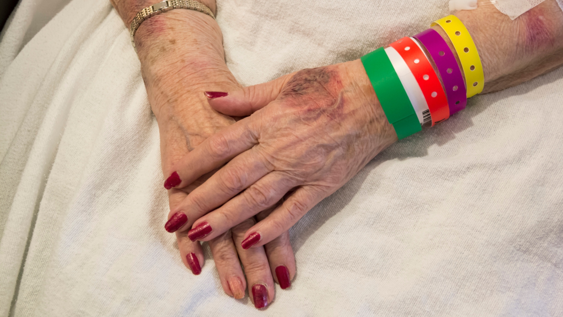 An elderly woman in the hospital with a bruised hand and multiple bracelets.